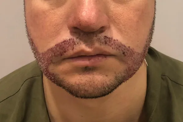 doloro-barba