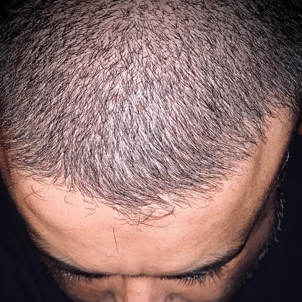 hair-loss-scale