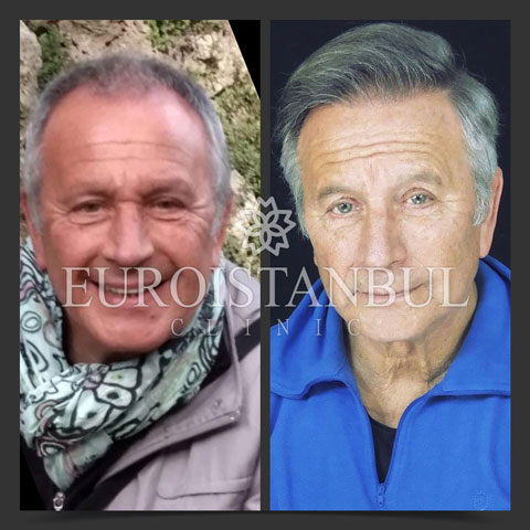 hair-transplant-before-after-1