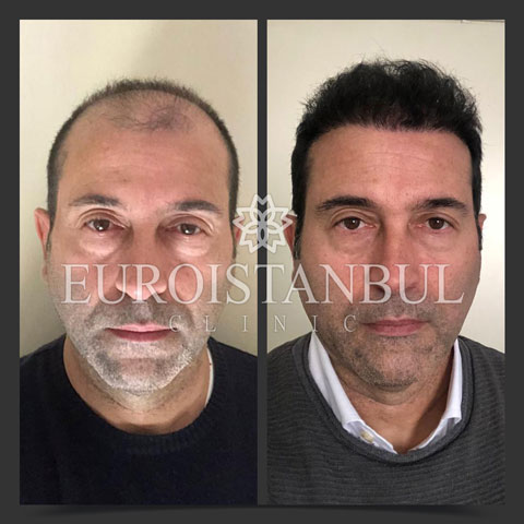 hair-transplant-before-after-10