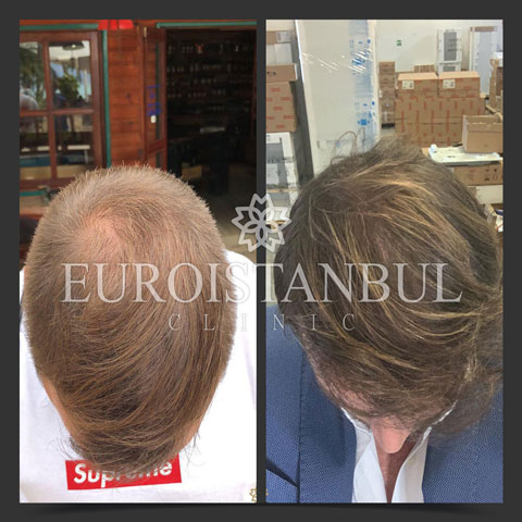 hair-transplant-before-after-2
