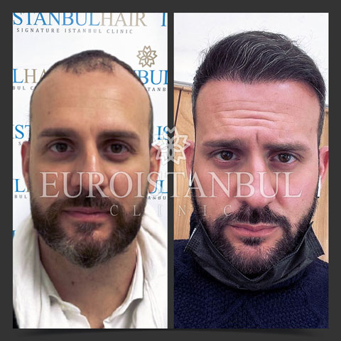 hair-transplant-before-after-3