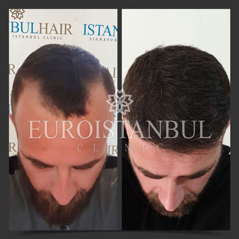 hair-transplant-before-after-4