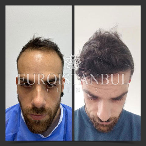 hair-transplant-before-after-5