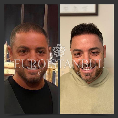 hair-transplant-before-after-6