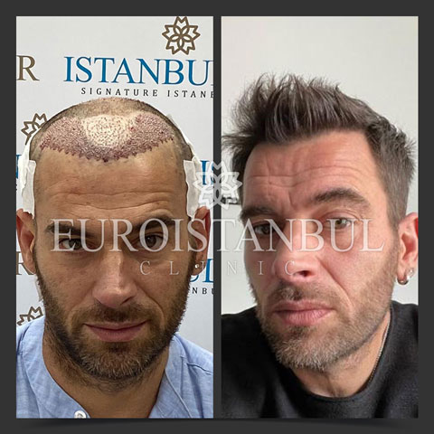 hair-transplant-before-after-7