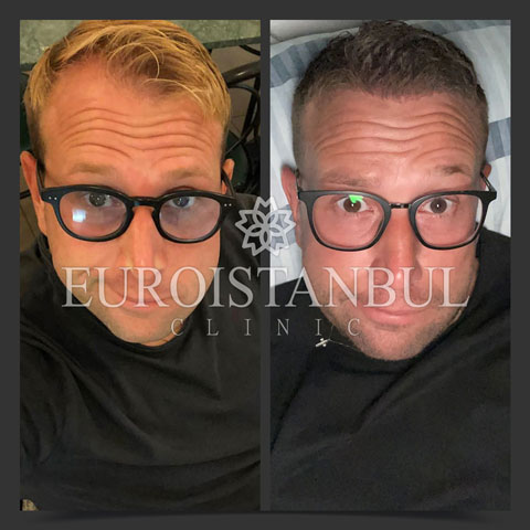 hair-transplant-before-after-8