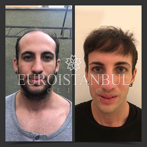 hair-transplant-before-after-9
