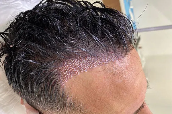 hair-transplant-without-shaving