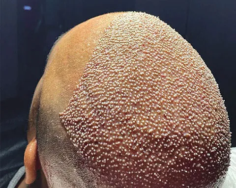 hair-transplantation-postoperative